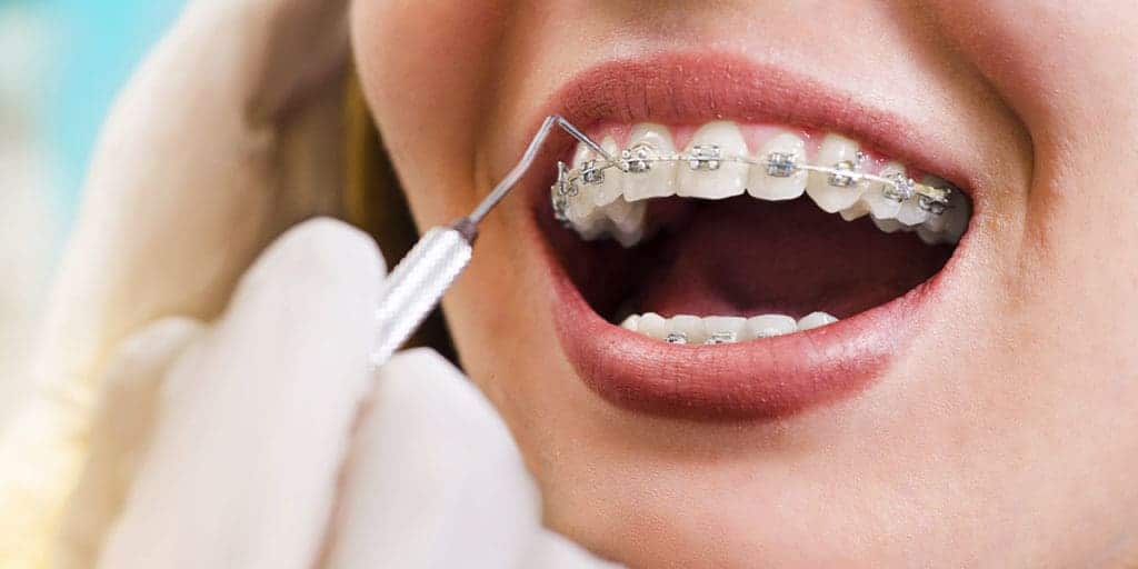 An-Overview-Of-The-Basic-Orthodontic-Treatments