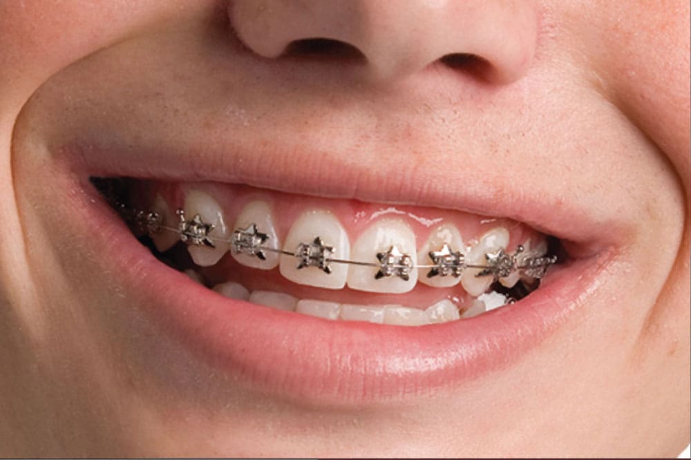 An-overview-of-the-braces-treatment-at-palm-valley-pediatric