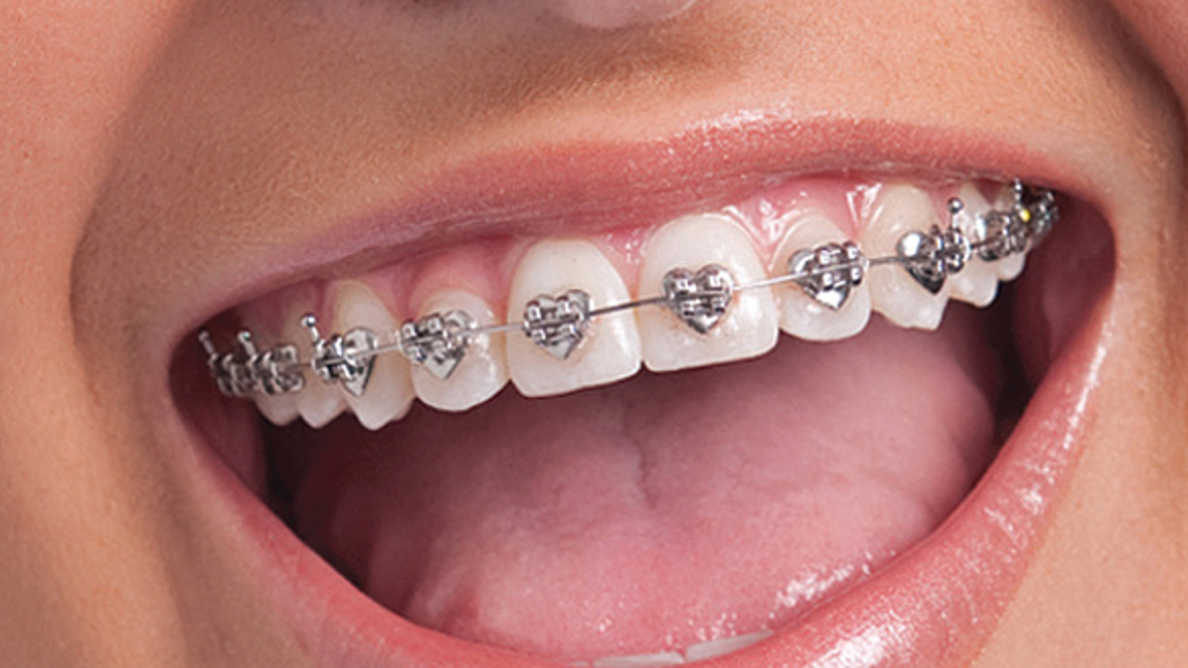 Signs That You Need An Orthodontic Treatment