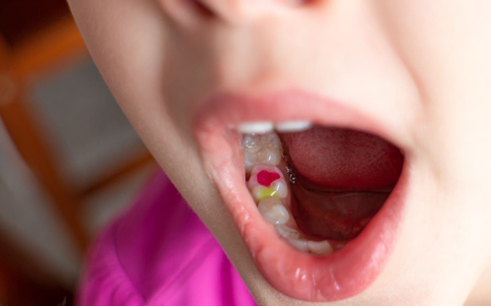 Dental-filling-for-kids