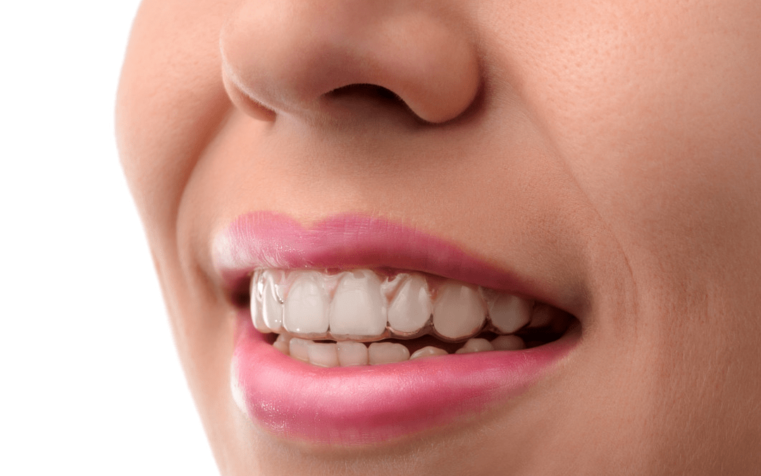 Straightening smiles with invisalign