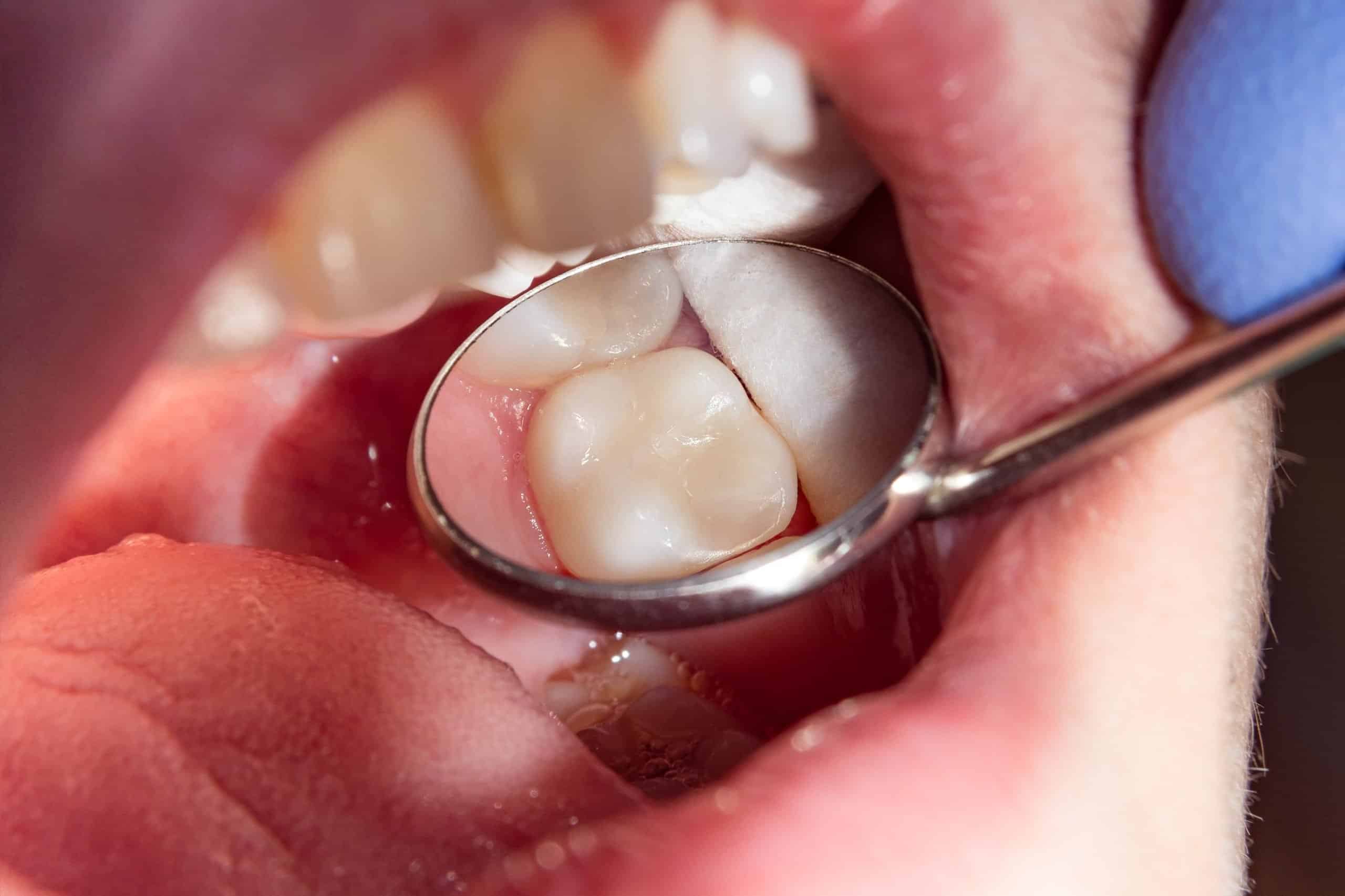 importance of timely fillings