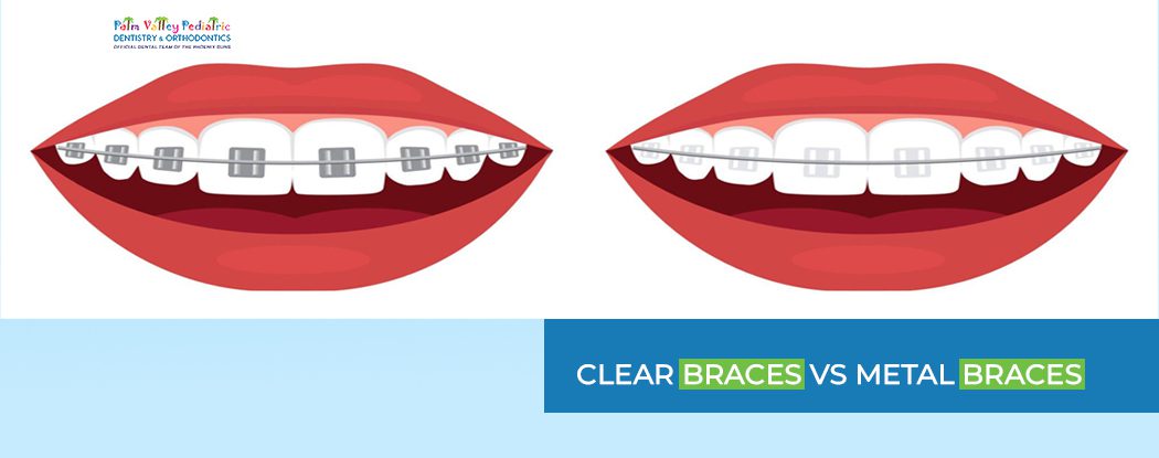 Clear Braces vs Metal Braces Pros & Cons: Comparison Guide - pvpd
