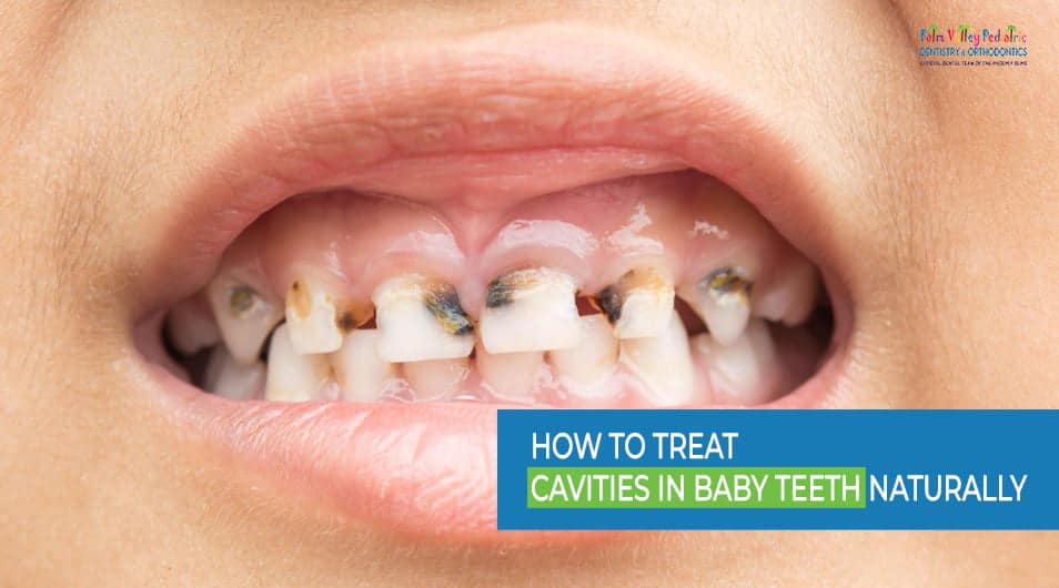How to Treat Cavities in Baby Teeth Naturally