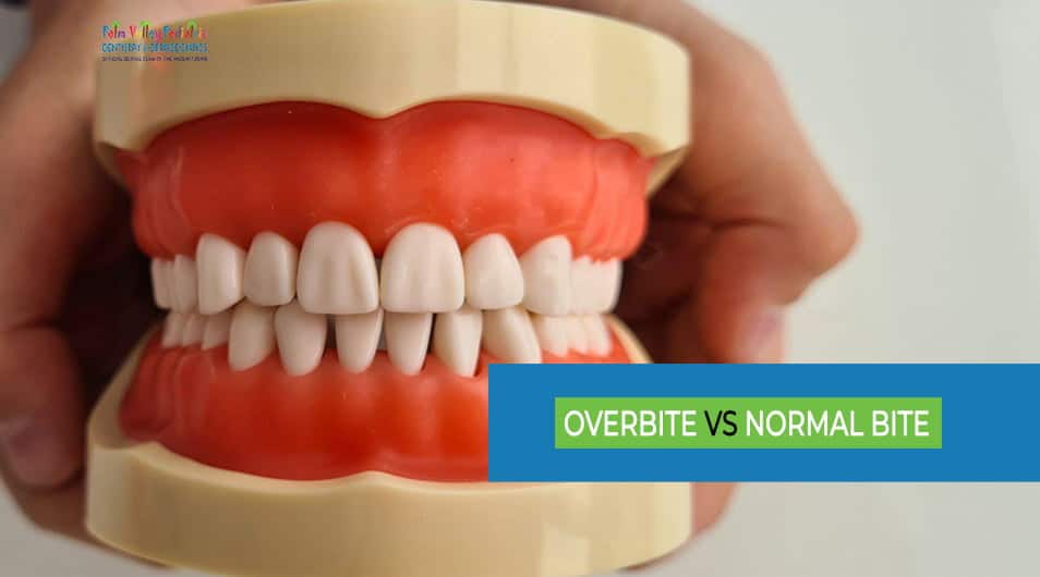 Overbite vs Normal Bite: Differences, Causes, and Treatment