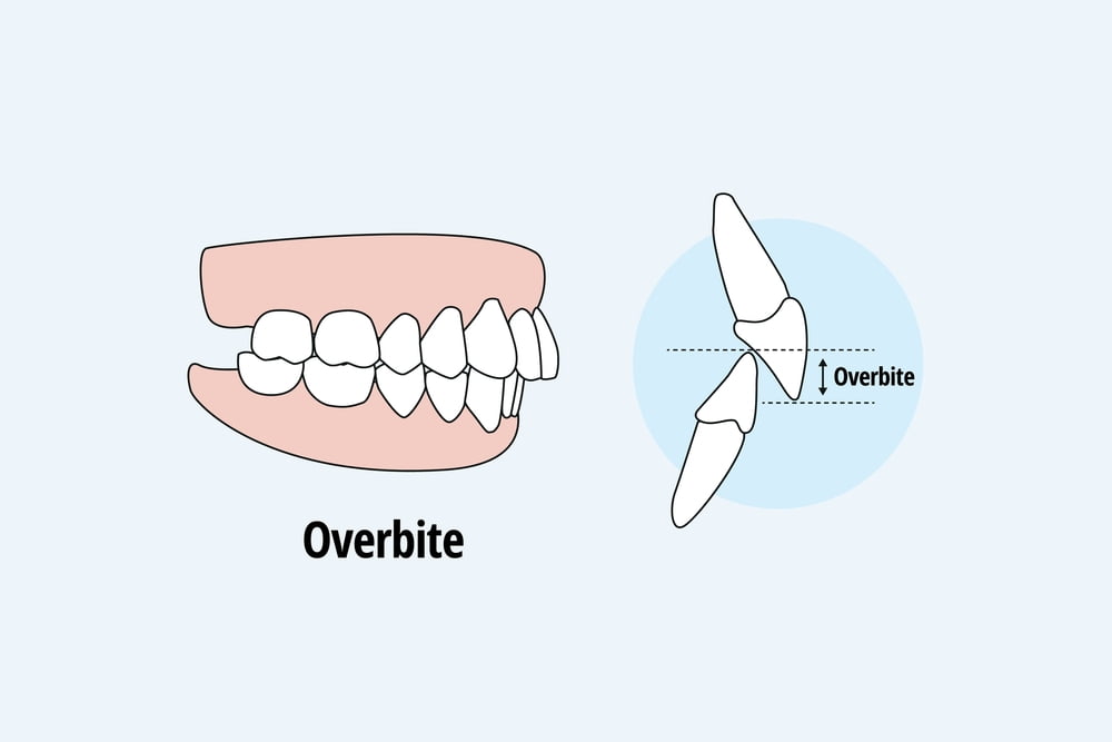 Overbite Condition: Protrusion of Upper Front Teeth