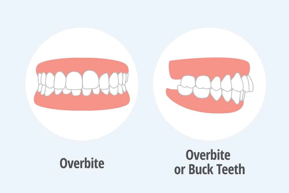 Illustration comparing overbite or buck teeth