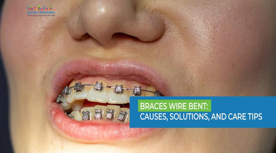 Braces Wire Bent-pvpd