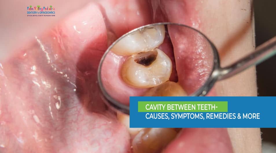 Cavity Between Teeth-pvpd