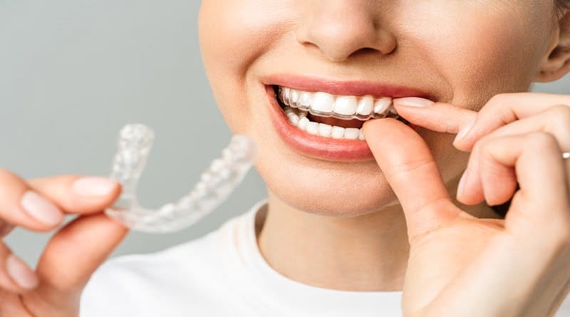 Invisalign Treatment for Kids - Invisible aligners for a confident smile