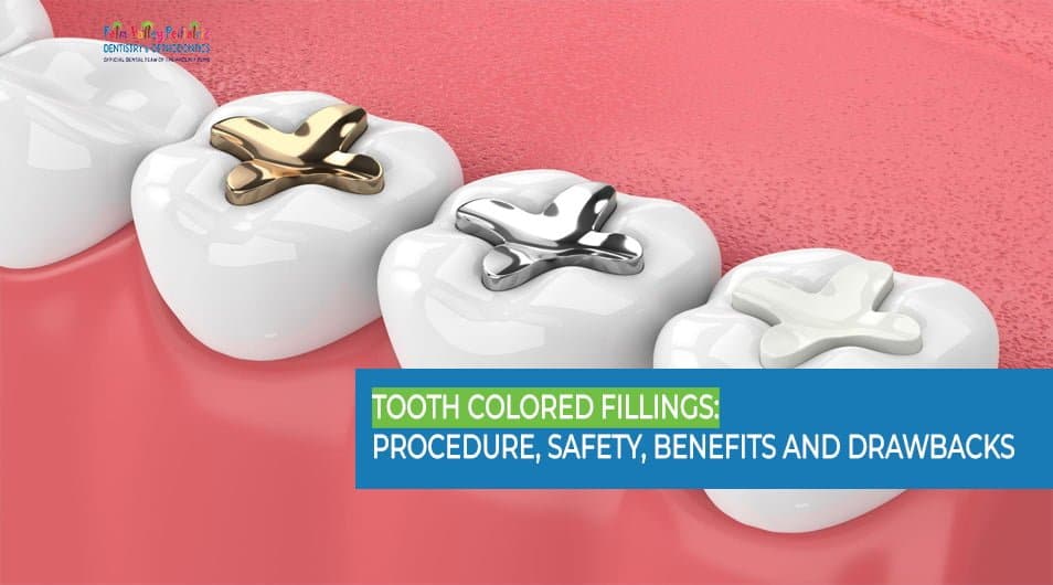 Tooth Colored Filling: Procedure, Safety, Benefits and Drawbacks - pvpd