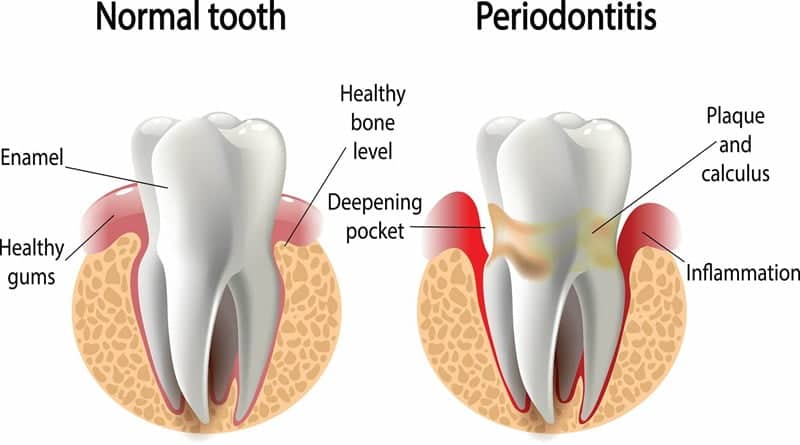 A Comparative Illustration of Normal Teeth vs. Periodontitis
