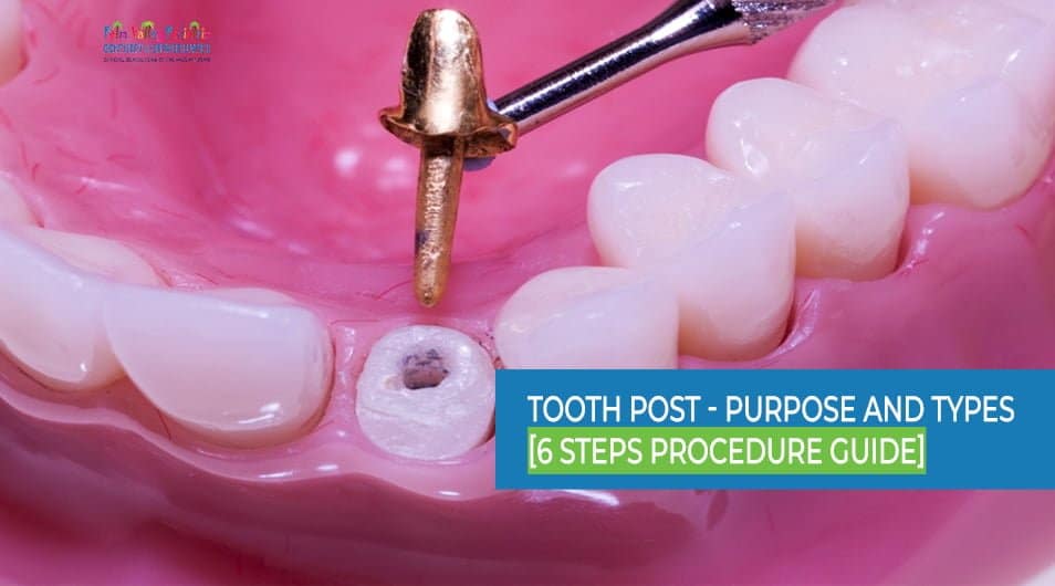 Porcelain Tooth Post crown preparation showcasing dental procedure for enhanced tooth support - pvpd