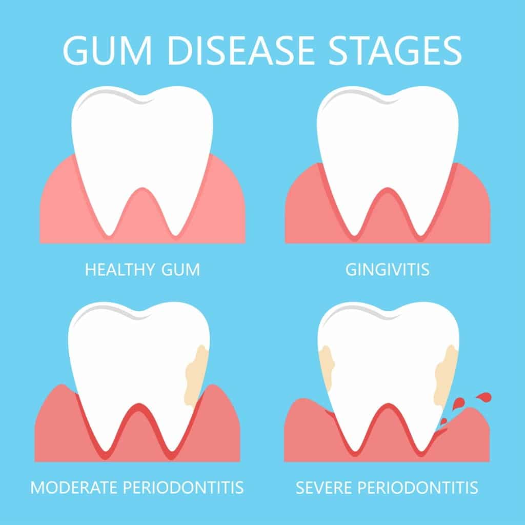 Understanding the Progression - Stages of Gum Disease - PVPD