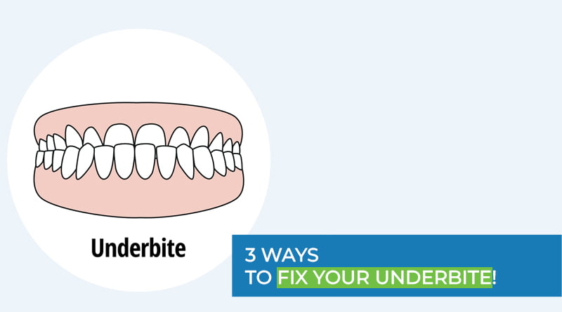 Underbite in children: Causes, Symptoms and Treatment - PVPD