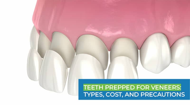 Teeth Prepped for Veneers - Types, Cost, and Precautions