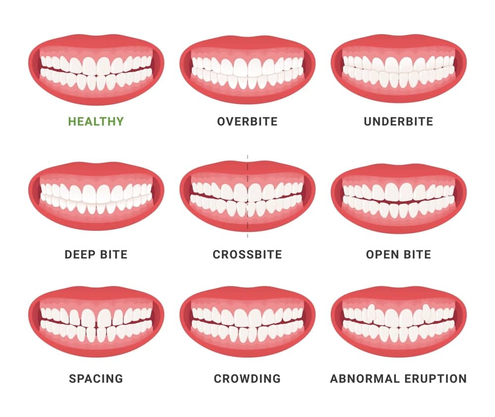 Vector illustration of human mouth jaws, comparing bad bite conditions and healthy dental anatomy
