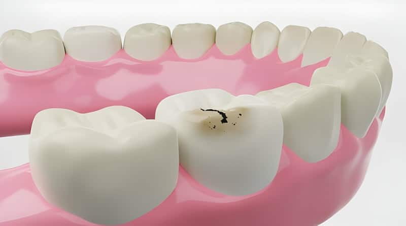 Visual representation of tooth decay in a 3D rendering