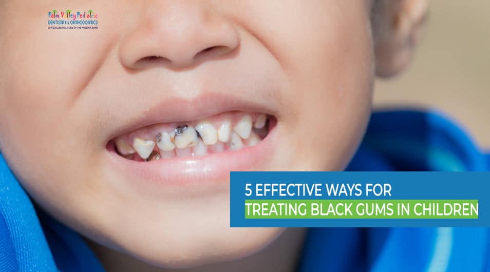 Black Gums in Kids: Causes, Treatments, and Consultation