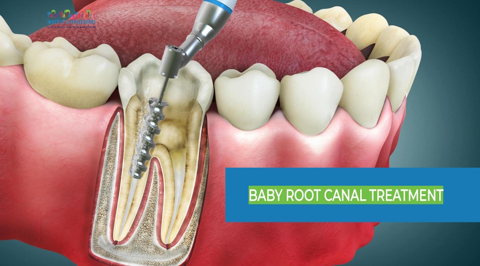 Baby Root Canal Treatment - Benefits, Signs, and Detailed Steps