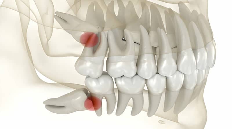 Medically Accurate 3D Illustration of Mesial Impaction in Wisdom Teeth