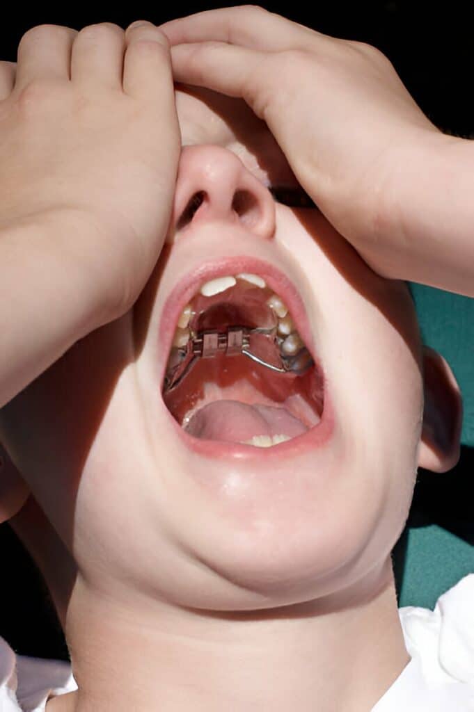 Baby Boy with Palatal Expander Preparing for Adjustment