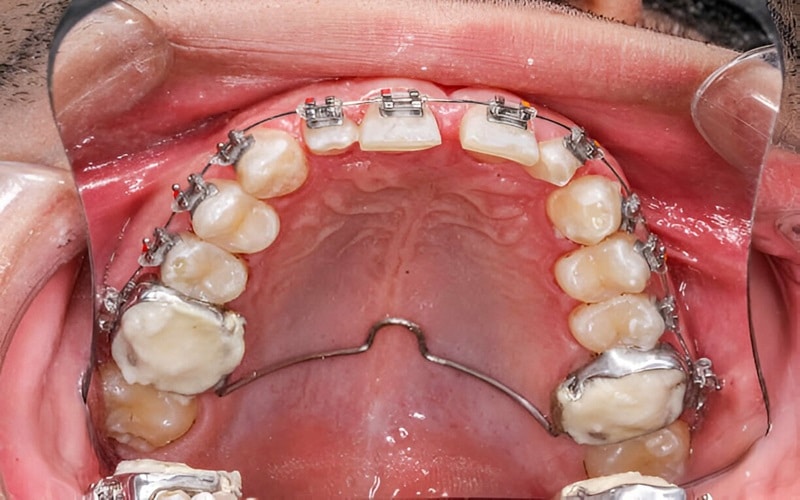 Close-up of orthodontic treatment showing a metallic arch wire palatal expander inside a patient's mouth.