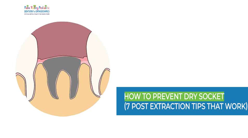 How to Prevent Dry Socket - 7 Post Extractions Tips That Always Work