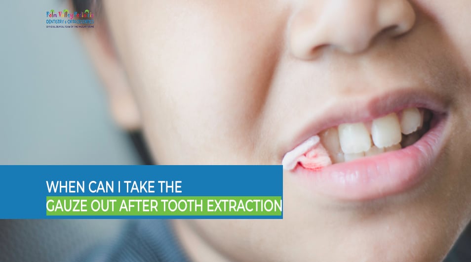 When Can I Take the Gauze Out After Tooth Extraction