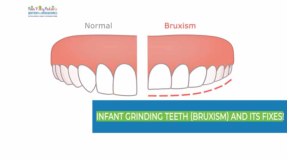 Illustration showing the negative consequences of bruxism in infants, highlighting dental damage and discomfort.