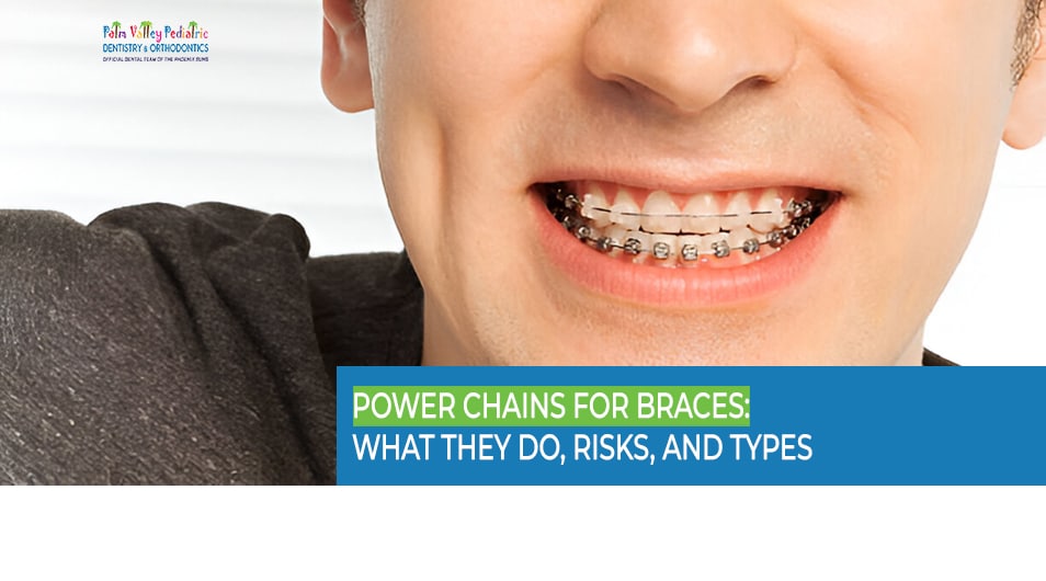 Power Chains for Braces - What They Do, Risks, and Types