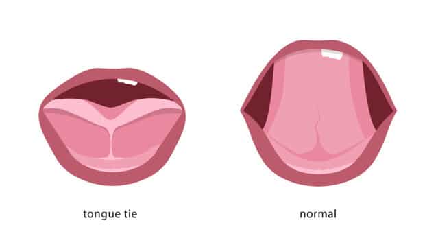 tongue Tie