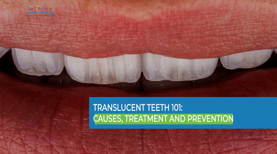 Translucent Teeth 101 - Causes, Treatment and Prevention - PVPD
