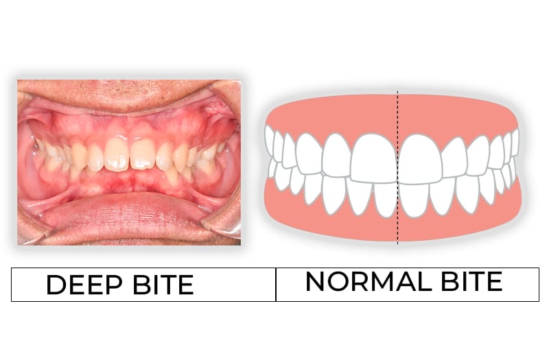 Comparison between deep bite and normal bite, showing the difference in how the upper and lower teeth align