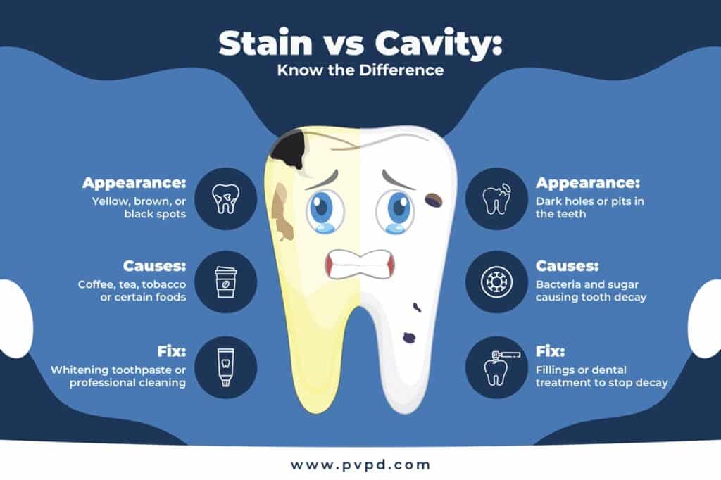Comparison of tooth cavities and stains - 3 key differences in appearance, causes, and treatments