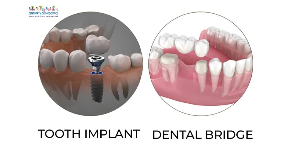 3D comparison of dental implant and dental bridge showing implant with titanium post and bridge with connected crowns