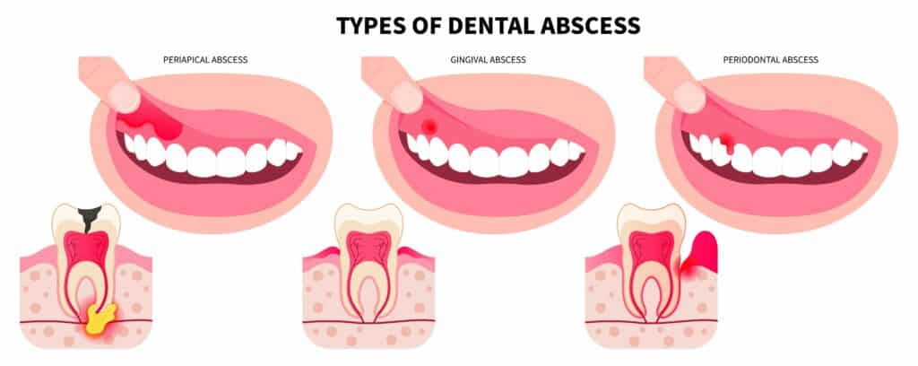 Types of dental abscess showing periapical, gingival, and periodontal abscess with cracked wisdom teeth, cavities, and swollen gums