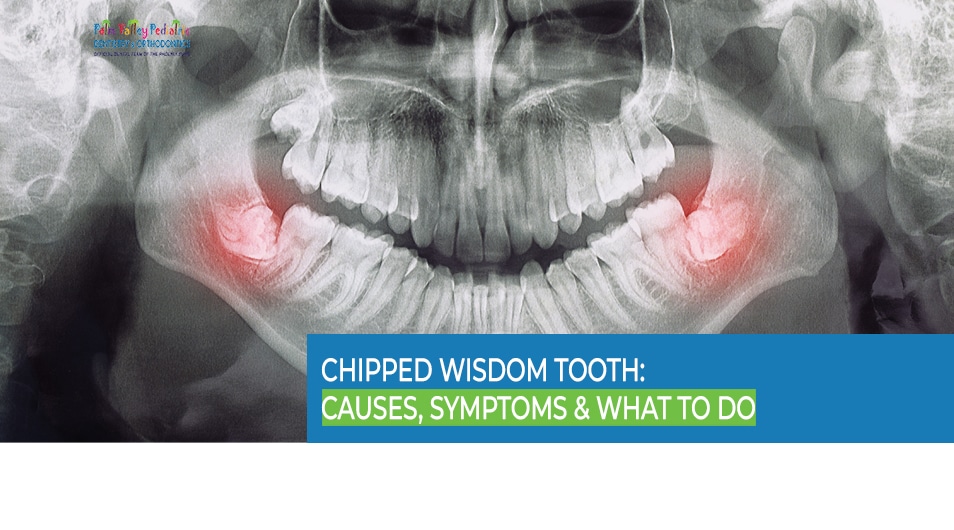 X-ray of a chipped wisdom tooth showing dental issues and causes