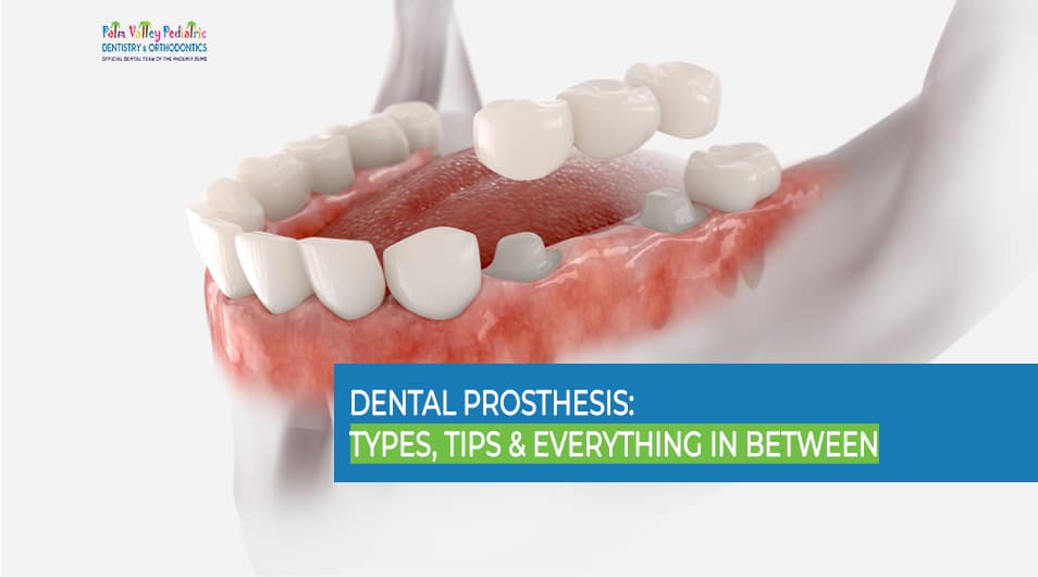 Bridge dental prosthesis with three artificial teeth fixed on molar and premolar