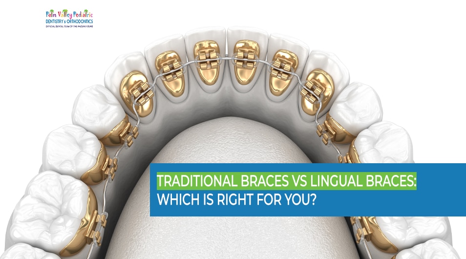 3D illustration of golden lingual braces system, highlighting differences between traditional braces and lingual braces.Golden lingual braces system depicted in a 3D illustration, showcasing an advanced orthodontic option compared to traditional braces.