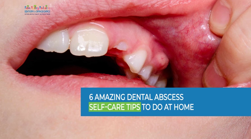 Dental Abscess Self-Care