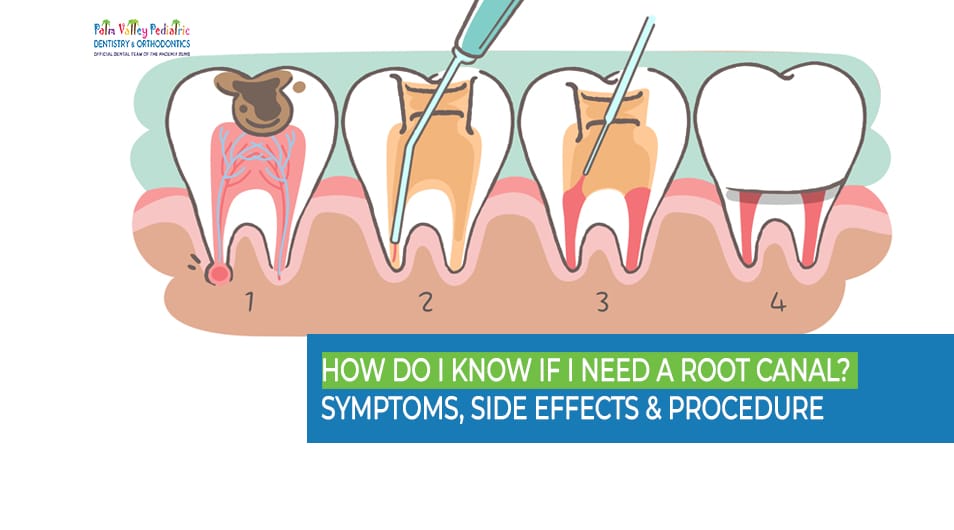 Tooth illustration showing root canal treatment and infected pulp removal