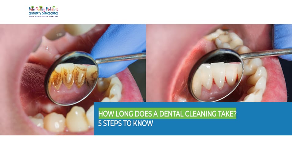 Plaque and calculus buildup removed during dental cleaning at PVPD