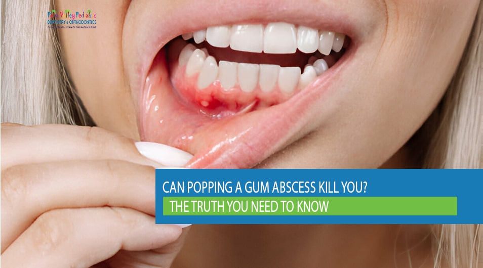 Close-up of gum abscess being examined by a dentist – Can popping a gum abscess kill you?